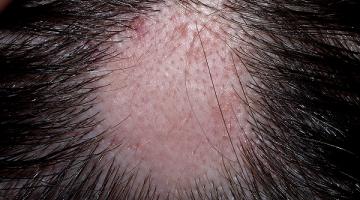 Alopecia Areata