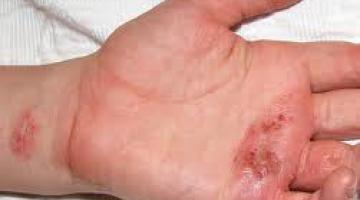 Dermatitis o Eccema Atópico