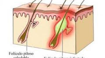 Foculitis del Cuero Cabelludo