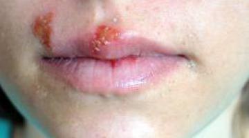 Herpes Recivantes