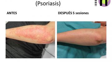 Psoriasis