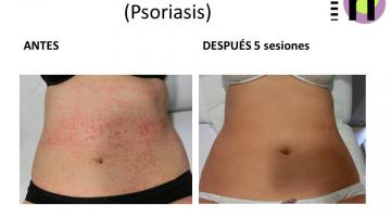 Psoriasis